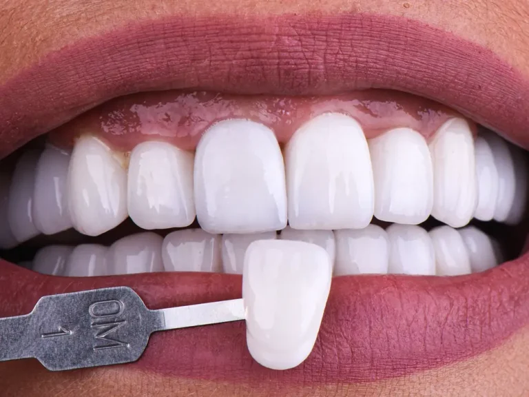 In an era of quiet glow-ups, no-prep veneers are the new ‘it’ cosmetic procedure